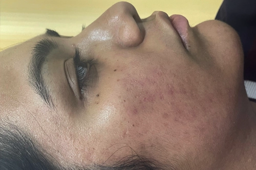 Acne Scar after