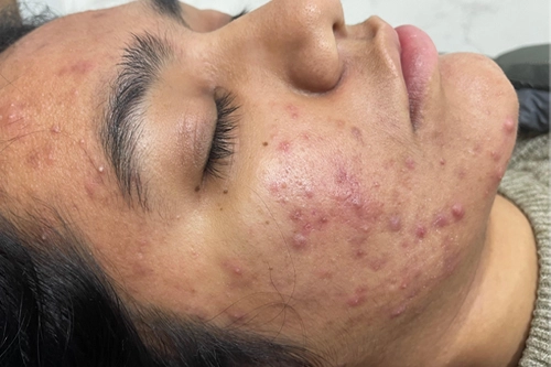 Acne Scar befor