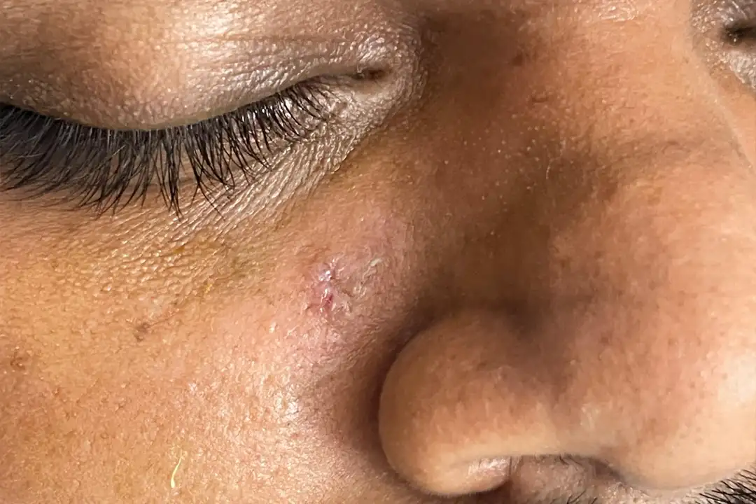 wart after