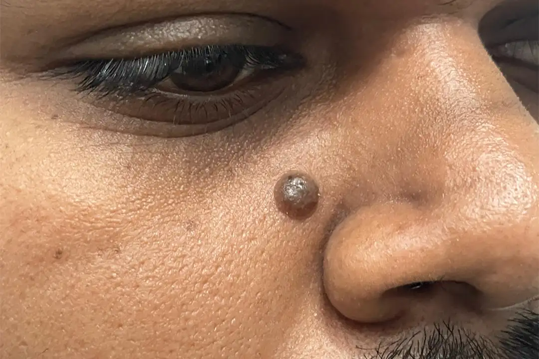 wart-before